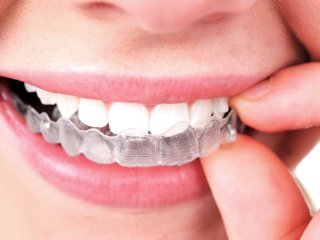 invisalign-vilanova invisalign-vilanova