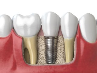 urpi-dental-anatomy-of-healthy-dents-and-tooth-dental-implant-PAF6ZMW urpi-dental-anatomy-of-healthy-dents-and-tooth-dental-implant-PAF6ZMW