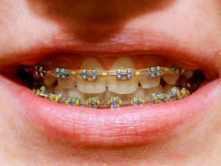 urpi-dental-beautiful-macro-shot-of-white-dents-with-braces-dental-care-photo-beauty-woman-smile-with-ortodontic_t20_rRWBaz urpi-dental-beautiful-macro-shot-of-white-dents-with-braces-dental-care-photo-beauty-woman-smile-with-ortodontic_t20_rRWBaz